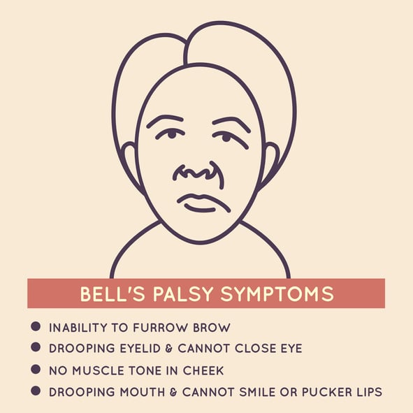 Bell S Palsy Versus Stroke What To Know